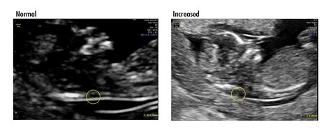 nuchal translucent prenatal screening